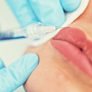 Injectare cu acid hialuronic